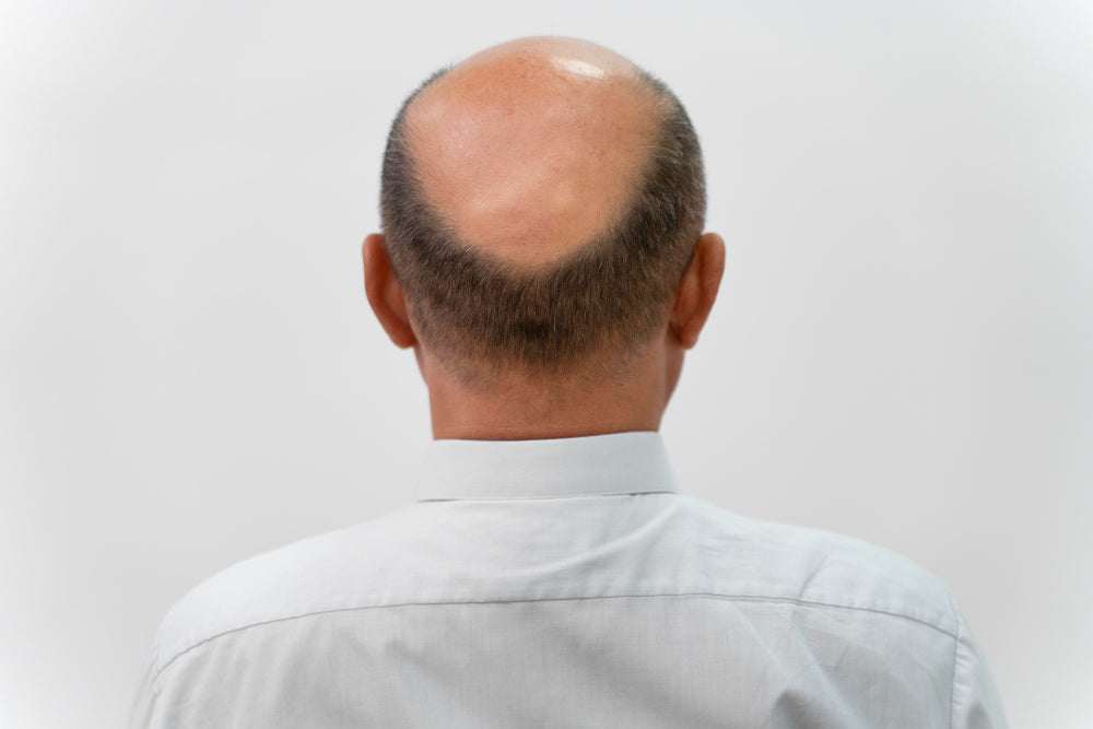 Men’s Hair Loss: Understanding the Causes and Solutions